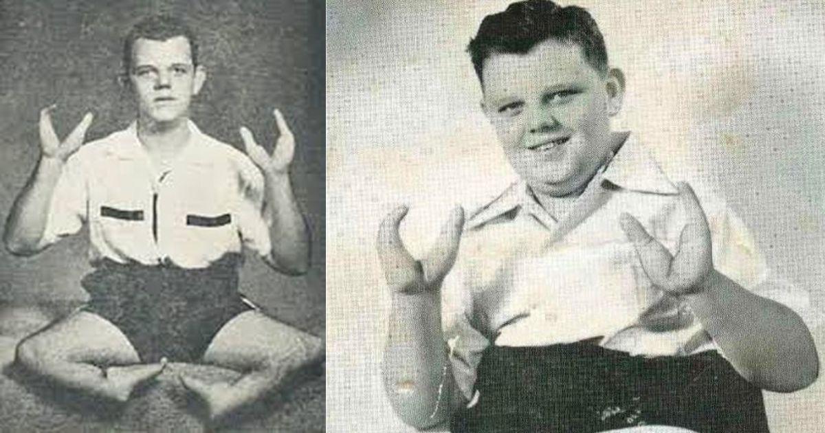 Lobster Boy Grady Stiles