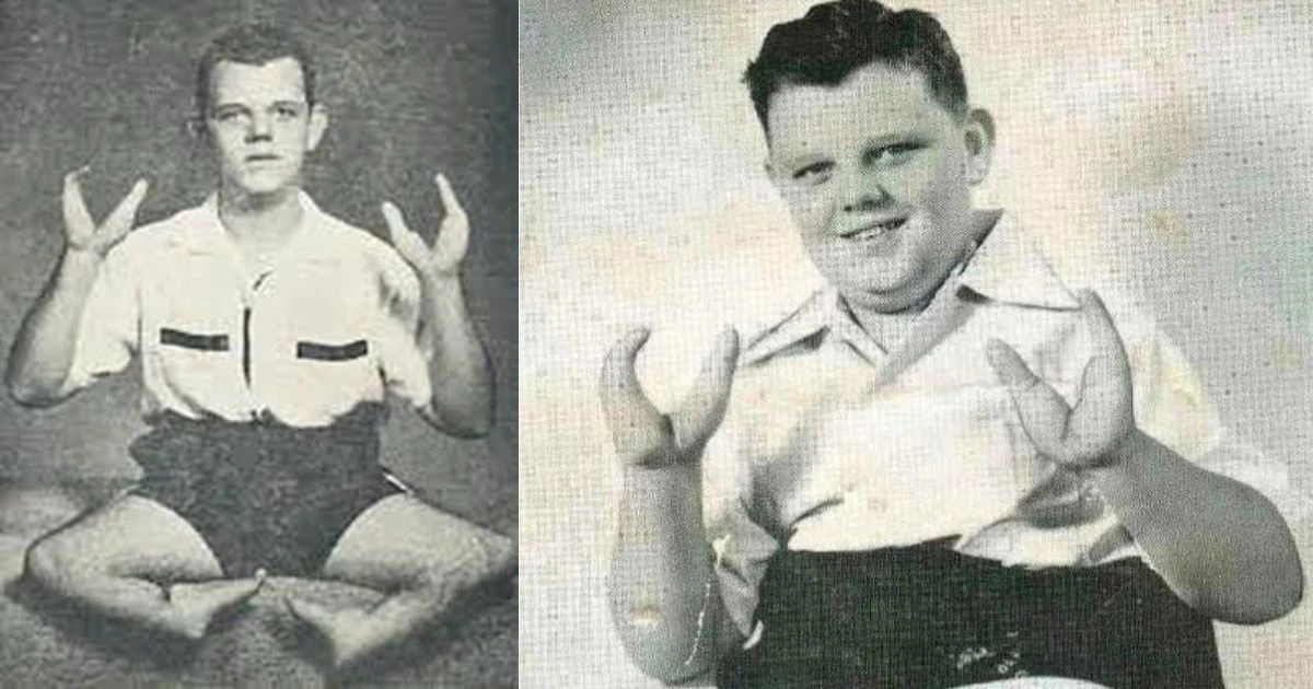 Hal Edwards ‘Lobster Boy’: The Shocking Rise and Violent Fall of Grady Stiles